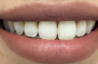 After - Maida Vale Dental Practice