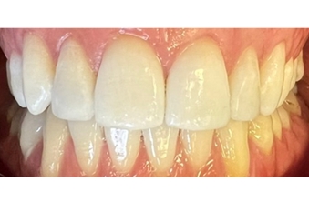 After - Maida Vale Dental Practice