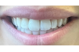 After - Maida Vale Dental Practice